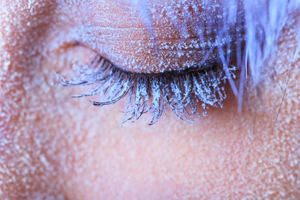 frostbite-and-frostnip-2192.jpg
