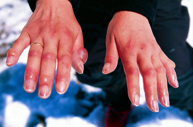 Severe-Frostbite-on-Fingers-Winky.jpg