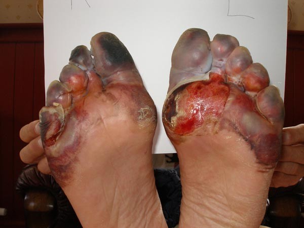 frostbite-feet.jpg