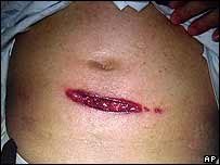 _39941701_ap203stomach.jpg