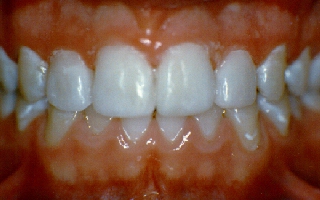Bonding%20Small%20Teeth%20After.JPG