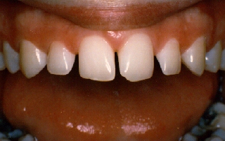 Bonding%20Small%20Teeth%20Before.JPG